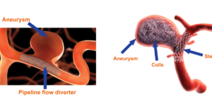 Brain aneurysm treatment at Dr Rao's Coiling and flow diverter