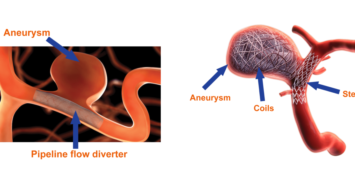 Brain aneurysm treatment at Dr Rao's Coiling and flow diverter