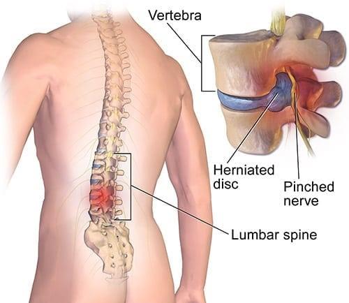 Back Pain, Back Injury, Back Surgeons
