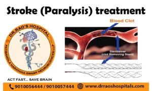 stroke-and-mechanical-thrombectomy at Dr Rao's Hosptial by Dr Rao