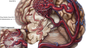 The-Best-Brain-arteriovenous-fistula-or-Malformations-treatment-in-Guntur