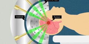 stereotactic-radiosurgery at Dr Rao's Hospital by stereotactic radiosurgeon Dr Rao