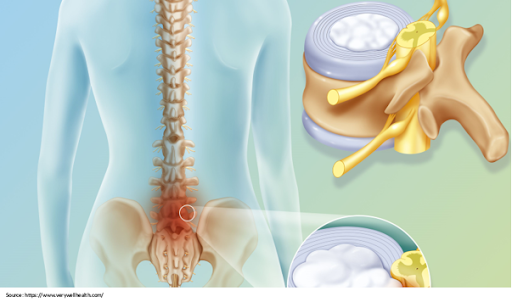 why-is-preoperative-counseling-required-before-spine-surgery
