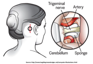 causes-symptoms-and-treatment-for-trigeminal-neuralgia-in-guntur-andhra-pradesh