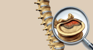 minimally-invasive-spine-tumor-surgery