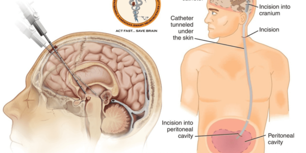 best-hydrocephalus-treatment-in-guntur-best-neurosurgeon-in-guntur-best-neurosurgeon-in-india