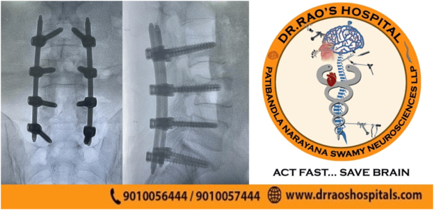 low-back-pain-surgery-at-guntur-best-minimally-invasive-spine-surgery-in-guntur-get-the-best-spine-surgery-in-guntur