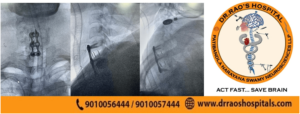 the-best-spinal-surgery-treatment-dr-raos-hospital-guntur