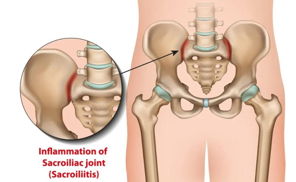 the-best-treatment-for-ankylosing-spondylitis-in-guntur-dr-raos