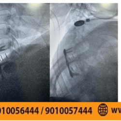 anterior-cervical-discectomy-and-fusion-acdf-the-best-at-dr-raos-guntur