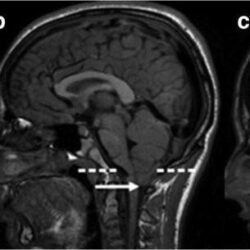 chiari-malformations-the-best-treatment-is-at-dr-raos-guntur