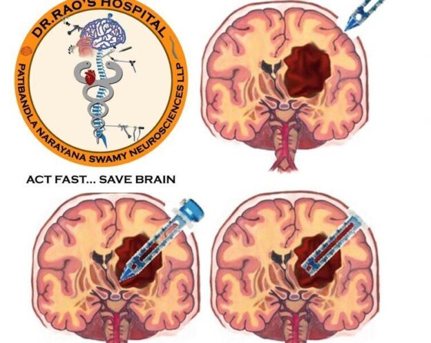 Brain Path - minimally invasive clot removal for intracerebral-hemorrhage-the-best-treatment-at-dr-raos-guntur by Dr Rao