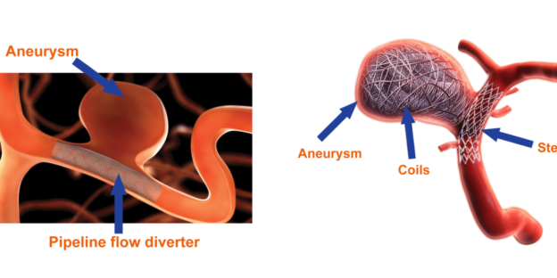 the-best-subarachnoid-hemorrhage-treatment-at-dr-raos