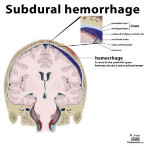 the-best-subdural-hemorrhage-treatment-at-dr-raos