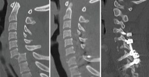 Post-op CT scan showing successful lateral mass screw fixation for spinal cord injury performed at Dr. Rao's Hospital