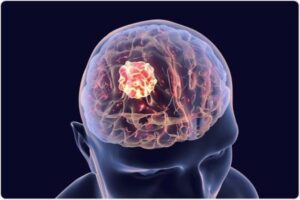 Neuro-Oncology: State-of-the-Art Treatments for Brain and Spinal Tumors