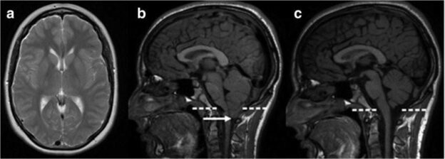 Advanced surgical options for Chiari Malformation treatment at Dr. Rao's Hospital, Guntur, Andhra Pradesh.