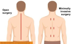 Comparison of Minimally Invasive vs. Traditional Open Neurosurgery: Choosing the Best Option