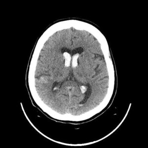 Intraventricular hemorrhage treatment at Dr. Rao's Hospital: Advanced care for brain bleeding. Contact us for expert neurosurgical treatment.