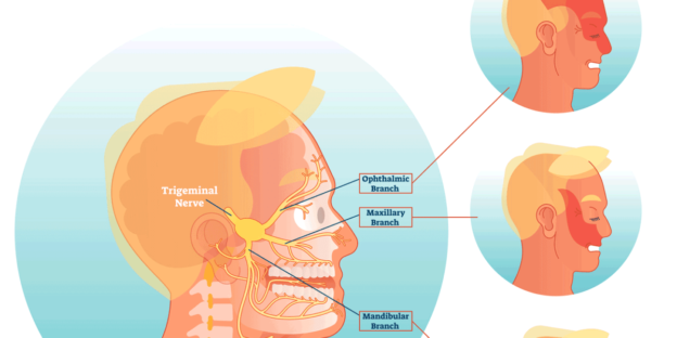 The Best Trigeminal Neuralgia Treatment: Causes, Symptoms, and Management Strategies
