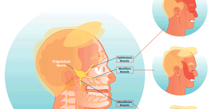 Best Trigeminal Neuralgia Treatment – Causes, Symptoms & Care