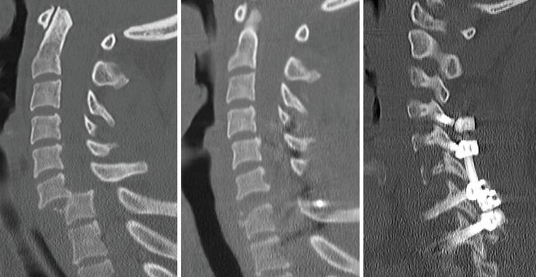 Acute-spinal-cord-injury