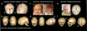 Craniosynostosis