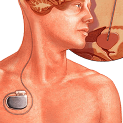 Deep Brain Stimulation: Revolutionizing the Treatment of Movement Disorders