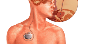 Deep Brain Stimulation: Revolutionizing the Treatment of Movement Disorders