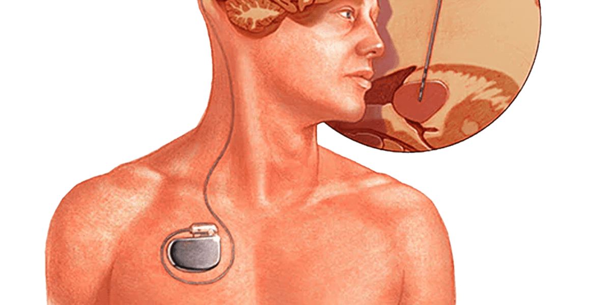 Deep Brain Stimulation: Revolutionizing the Treatment of Movement Disorders