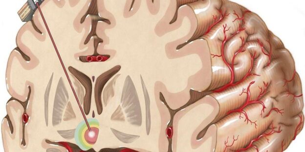 Deep Brain Stimulation for Epilepsy: A Promising Treatment Approach