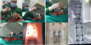 Key Factors in Choosing a Neurosurgery Hospital - Dr. Rao at Dr. Rao's Hospital - minimally invasive spien surgery