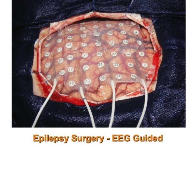 Epilepsy surgery by Dr Rao at Dr Rao's Hospital, ECOG based