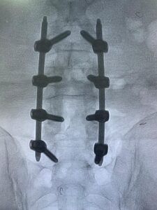 Finding the Nearest Hospital for Spine Surgery - Dr. Rao at Dr. Rao's Hospital