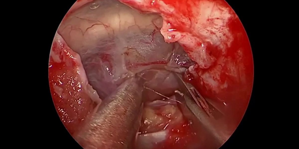 Craniopharyngioma