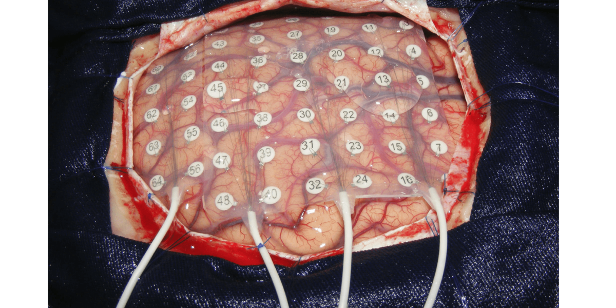 Epilepsy-Surgery-EEG-Guided