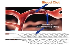 stroke-and-cerebrovascular-surgery - minimally invasive mechanical thrombectomy - at Dr Rao's by Dr Rao