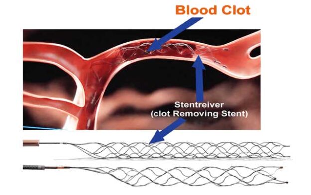 stroke-and-cerebrovascular-surgery - minimally invasive mechanical thrombectomy - at Dr Rao's by Dr Rao