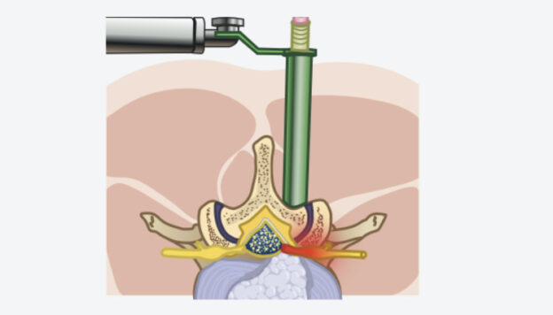 Illustration of a microdiscectomy procedure showing a patient's skull partially opened to expose the brain, performed in a modern operating room.