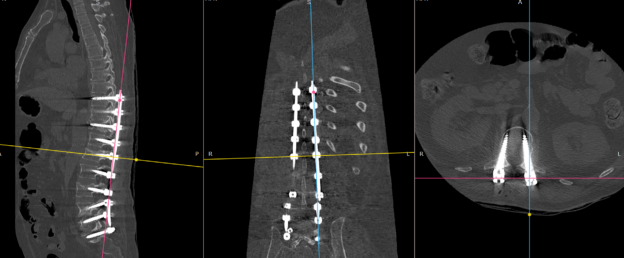 X-ray or medical imaging showing an osteoporotic fracture and its stabilization with surgical or minimally invasive techniques