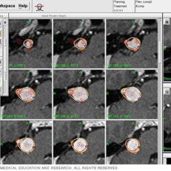 MRI-based stereotactic radiosurgery planning screen showing dose contours for brain arteriovenous malformation treatment.
