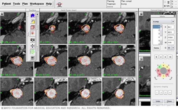 MRI-based stereotactic radiosurgery planning screen showing dose contours for brain arteriovenous malformation treatment.