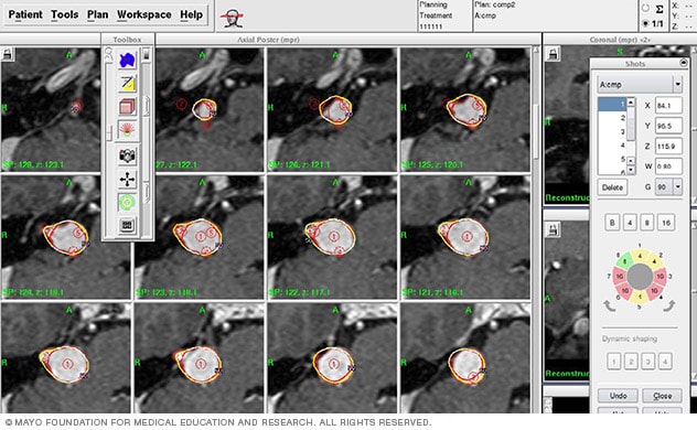 MRI-based stereotactic radiosurgery planning screen showing dose contours for brain arteriovenous malformation treatment.