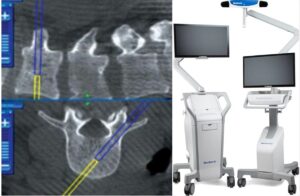 Medtronic StealthStation S8 neuronavigation system used for image-guided neurosurgery and precision planning at Dr. Rao’s Hospital, Guntur.